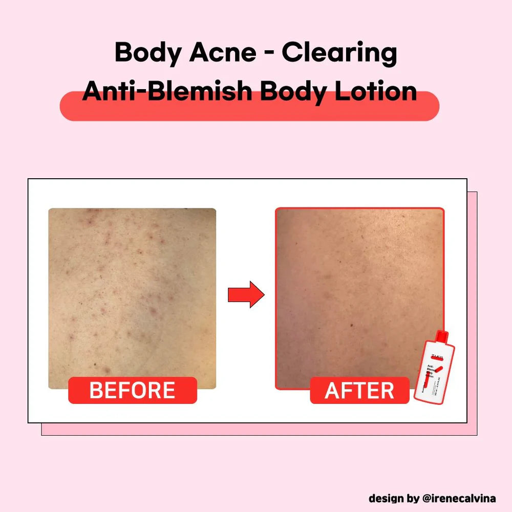 Tiam Anti-blemish Body Lotion